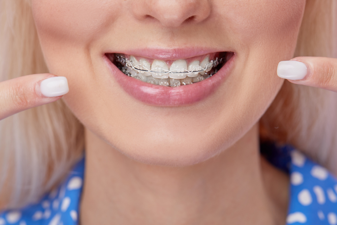 Clear braces zoomed in